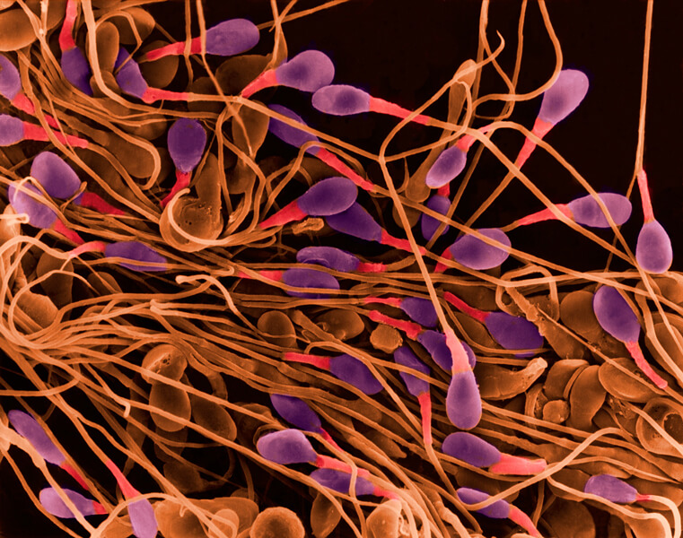 Scanning electron microscopy image of human sperm cells. One of the more plausible environmental links to autism is age of the father. Over a man’s lifetime, genetic changes accrue in the cells that give rise to sperm. Among them are alterations in genes that can raise the risk of autism.