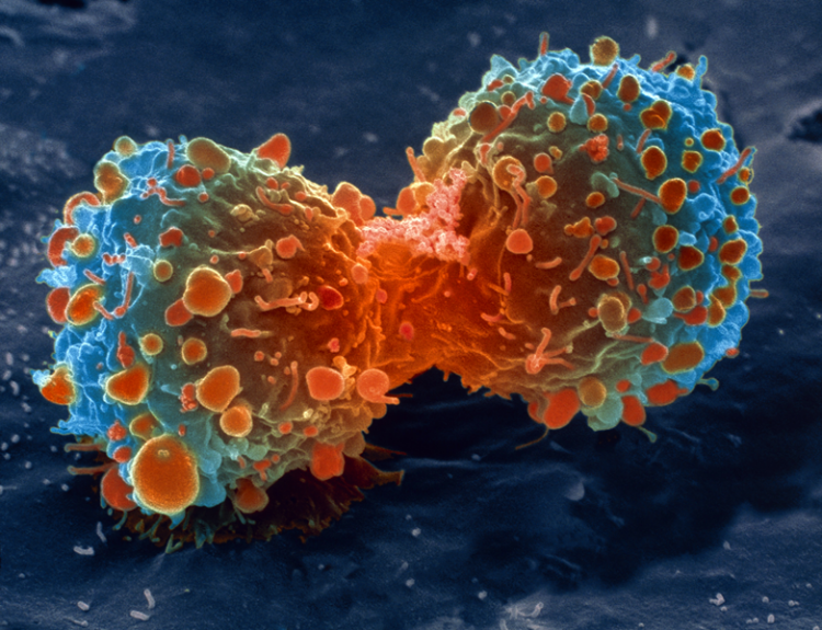 Colored scanning electron micrograph of a dividing lung cancer cell.