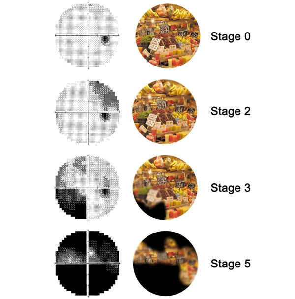 Diagram shows four stages of glaucoma’s progression, depicted as dark pixels in a gray scale visual field and as blurred dark spots in a simulation of what the patient sees.