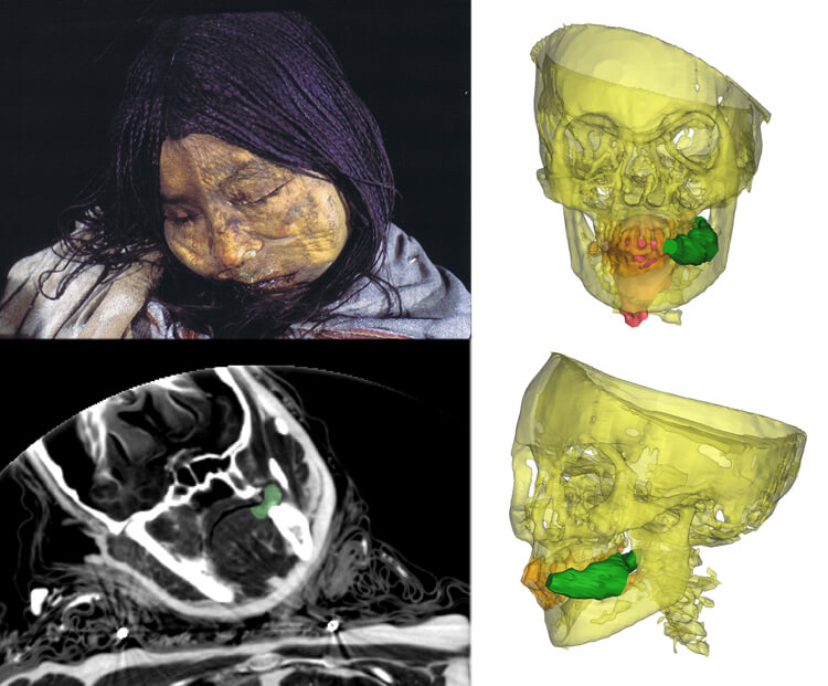 Image of a frozen mummy found entombed near the top of the Llullaillaco volcano in northwest Argentina. Known as the Llullaillaco Maiden, the 13-year-old was ritually killed in an Inca rite hundreds of years ago. An X-ray image reveals a wad of coca leaves clenched between her teeth.