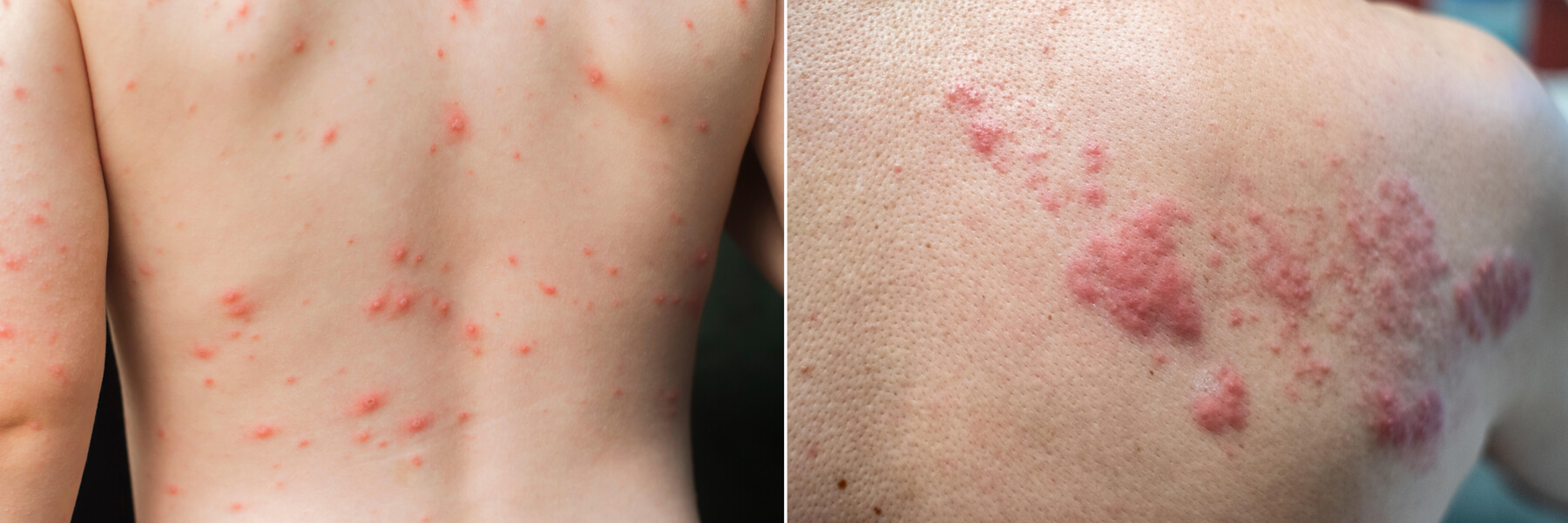 Chickenpox and shingles Photograph of two backs with red welts on them. The one on the left is a chickenpox rash and the one on the right, a case of shingles.