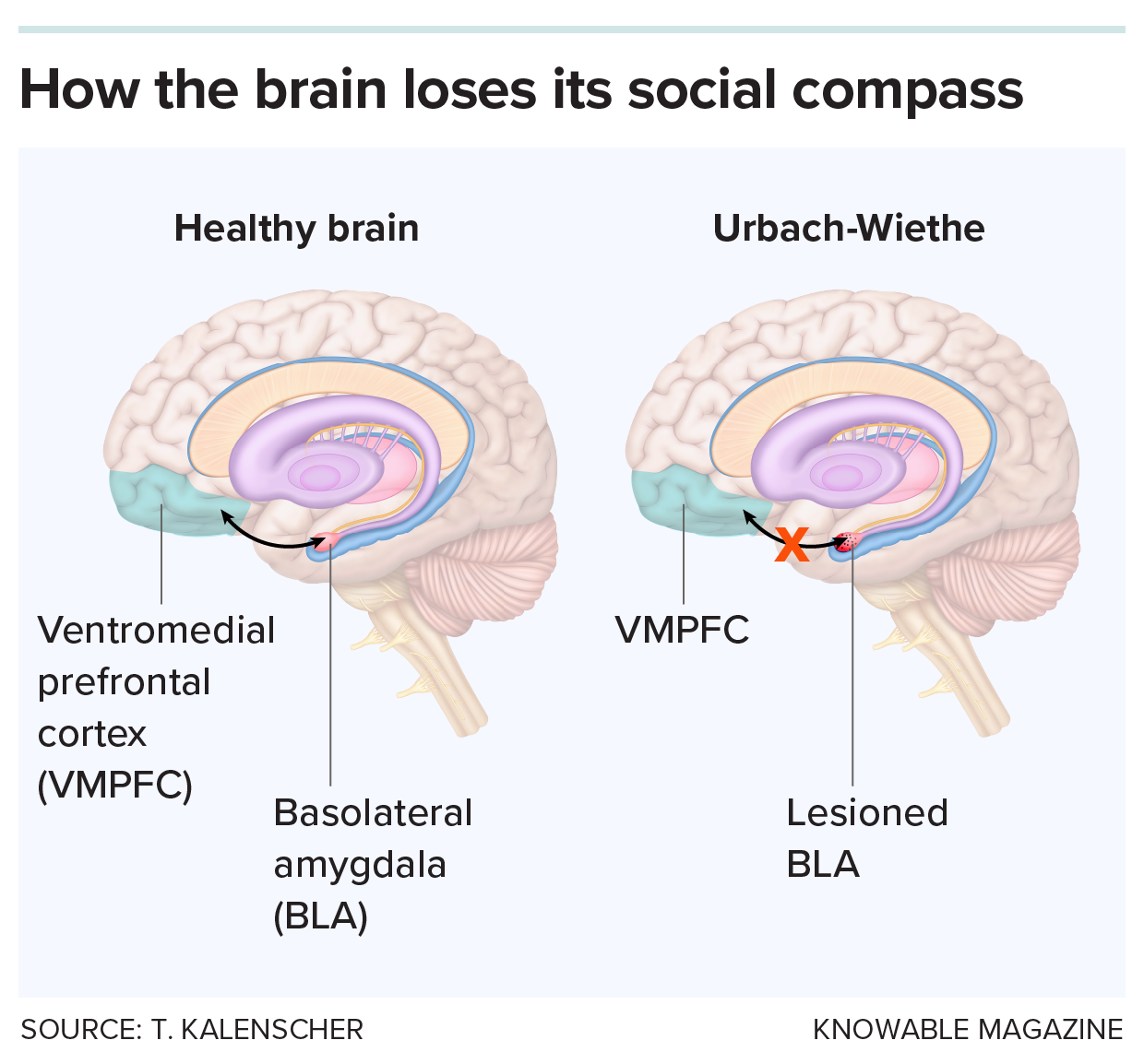 Social decision-making A graphic compares functioning in social decision-making in a brain of someone with Urbach-Wiethe disease and a normal brain.