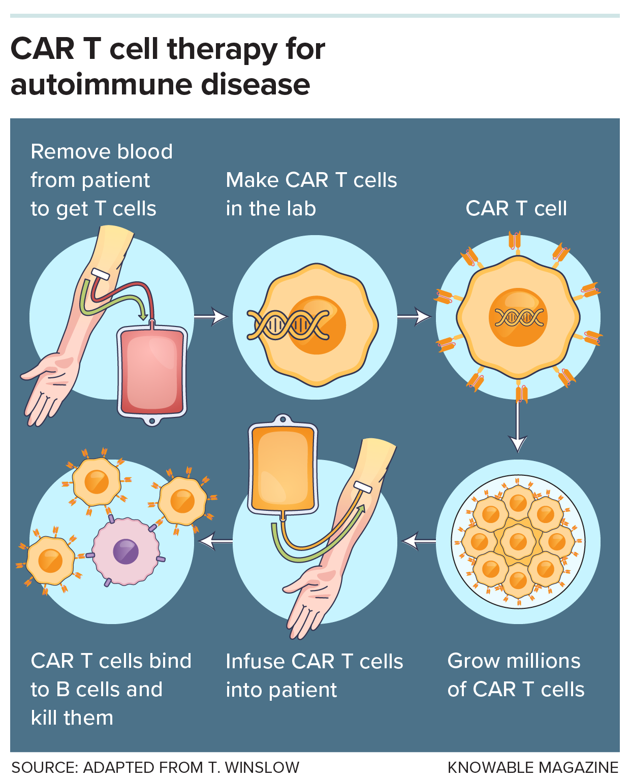 CAR T cell therapy for autoimmune disease A diagram depicts the procedure for CAR-T therapy, starting with removal of patient blood, then genetic reprogramming of T cells into CAR T cells, which are grown and then infused back into the patient, where they bind and kill B cells.